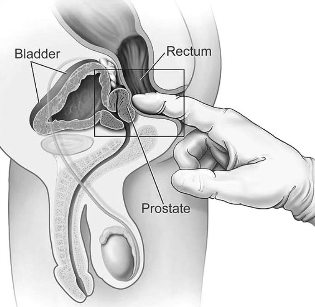 die Behandlung der Prostatitis im Haus Massage