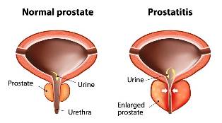 akute Prostatitis Behandlung