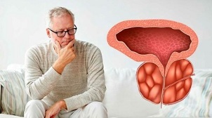 Ursachen der bakteriellen Prostatitis bei Männern